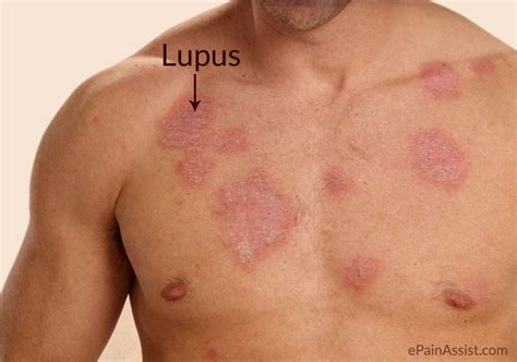 Lupus: Causes, Signs, Symptoms, Treatment, Lifestyle Modifications