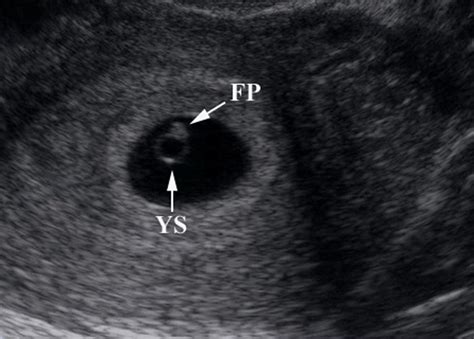 OB/Gyn Images | Emergency Ultrasonography