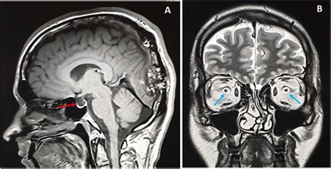 Sagittal T1 MRI image showing empty Sella turcica (red arrow) (a) and... | Download Scientific ...