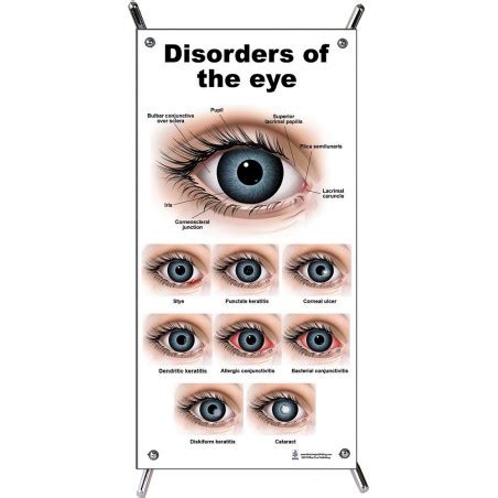 Eye Disorders Small Poster