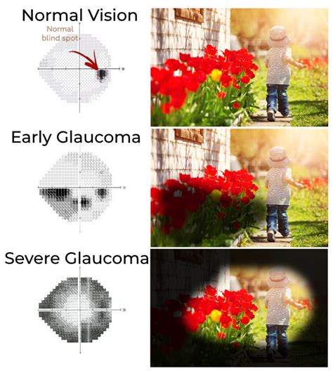 Glaucoma Madison | Glaucoma Symptoms | Anderson & Shapiro