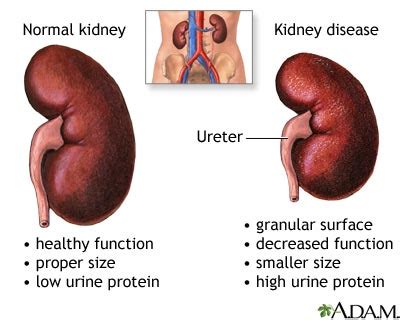 Diabetic nephropathy: MedlinePlus Medical Encyclopedia Image