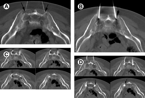 Sacroplasty - Techniques in Vascular & Interventional Radiology