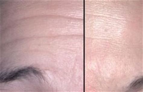 Wrinkle Fillers – Best Deep, Instant Injectable, Topical & OTC Face Wrinkle Filler Before and ...