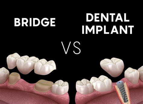 Dental implant or bridge What is better? - DentusDentino