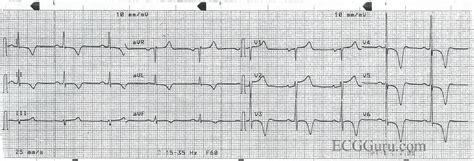 Deep, Symmetrical T Wave Inversions | ECG Guru - Instructor Resources