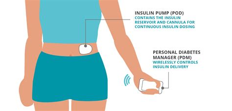 Insulin Pumps: Types & How They Work | Omnipod UK!