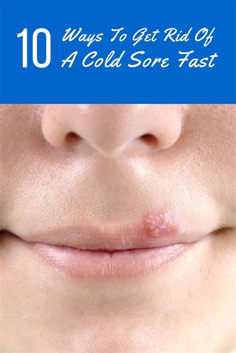 10 Ways To Get Rid Of A Cold Sore Fast | Cold sore, Healing cold sore, Canker sore