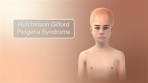 Hutchinson-Gilford Progeria Syndrome Depicted Using Medical Animation