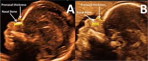 What Does A Down Syndrome Ultrasound Look Like - Captions More