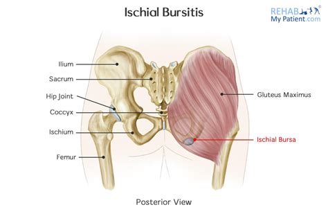 Ischial Bursitis | Rehab My Patient | Ischial bursitis, Bursitis, Trochanteric bursitis