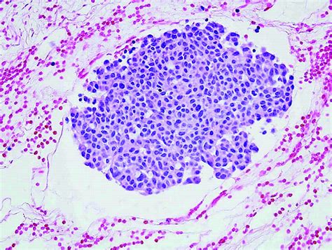 Current Management of Medullary Thyroid Cancer - Sippel - 2008 - The Oncologist - Wiley Online ...