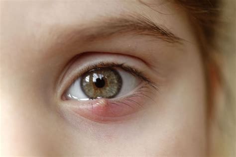 Chalazion vs. Stye: What Are the Differences Between the Two? | MyVision.org