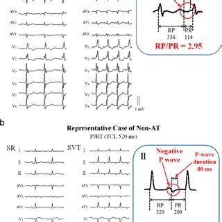 (a) RP/PR ratio in long RP tachycardia ECGs from patients with and... | Download Scientific Diagram