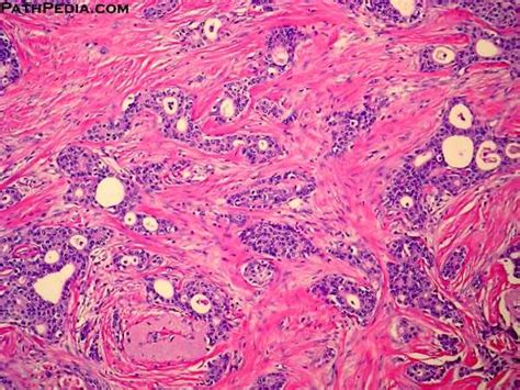 Histopathology images of Invasive ductal carcinoma, NOS by PathPedia.com: Pathology e-Atlas