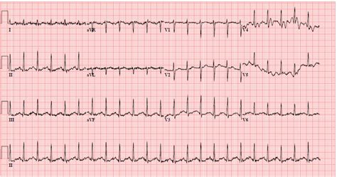 Sinus Tachycardia And Svt | Hot Sex Picture