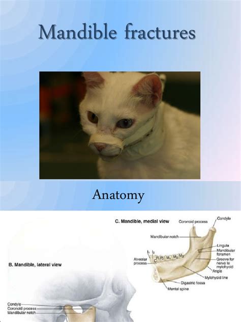 Mandible Fractures | PDF | Diseases And Disorders | Traumatology