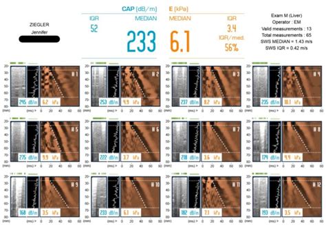 My FibroScan Experience and Test Results