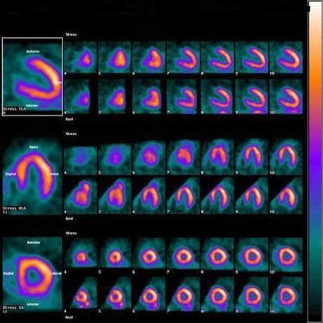 SPECT & PET Nuclear Stress Test | Cardiovascular Medical Group of Southern California