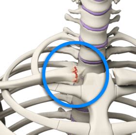 SC Joint Injury Houston, TX | SC Joint Reconstruction Houston, TX