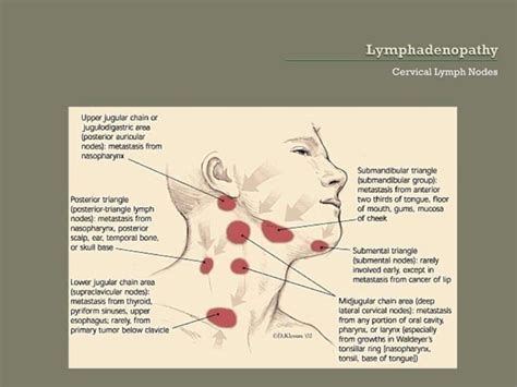 Lymphadenopathy