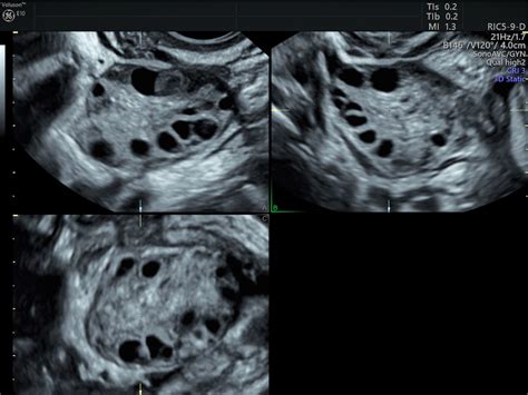 PCOS Diagnosis & The Role of Pelvic Ultrasound | Empowered Women's Health