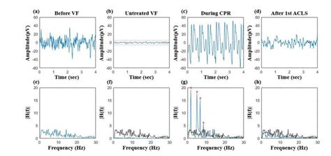 EEG changes in animal 1: (a) irregular baseline EEG activity before VF,... | Download Scientific ...