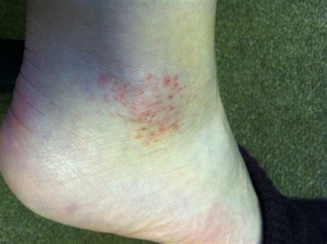 I have a red rash on my right ankle with small raised bumpsand