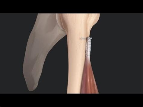 Biceps Tenotomy vs. Tenodesis: Literature Review and Rationale for ...