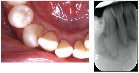 The root of the problem – external cervical resorption – Dentistry Online