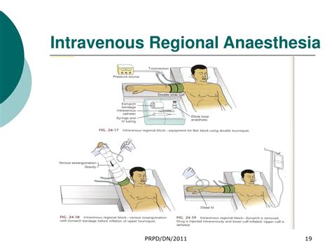 PPT - Types of Anaesthesia PowerPoint Presentation, free download - ID:9394494