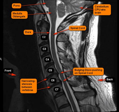 How Anterior Cervical Disk Fusion Surgery Improved My Life - Patient's Lounge