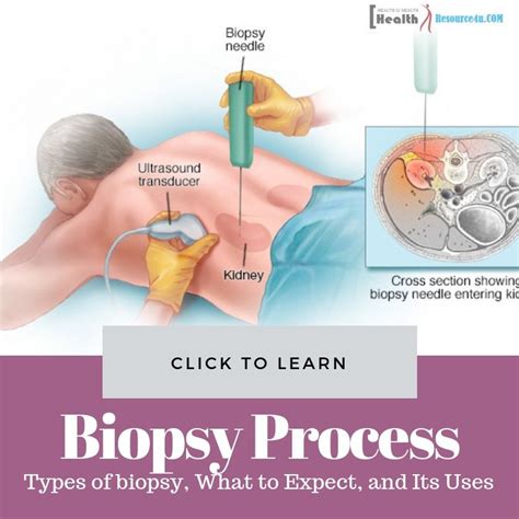 Biopsy: Types of biopsy, What to Expect, and Its Uses | Types of diseases, Ulcers, Medical ...