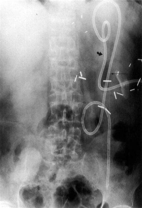 A gastrojejunostomy feeding tube placed into the gastric remnant ...