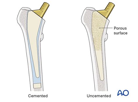 Hemiarthroplasty For Femoral Neck And Head Fractures With, 57% OFF