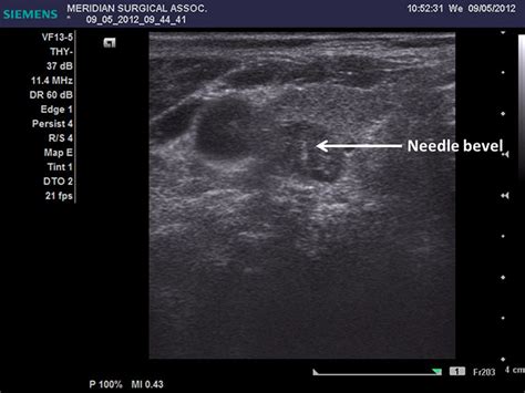 Thyroid Biopsy by Alexander Shifrin, MD | www.Thyroid-Biopsy.com