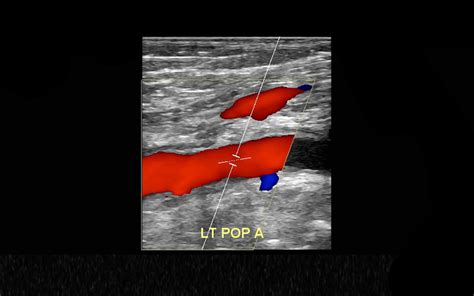 Arterial Duplex Exams in Cumming and Suwanee, GA | North Atlanta ...