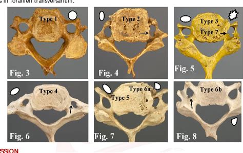 Table 1 from ANATOMICAL VARIATIONS IN FORAMEN TRANSVERSARIUM OF TYPICAL CERVICAL VERTEBRAE AND ...