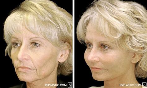 Before and After photo of a Face Lift procedure performed by Dallas ...