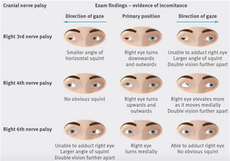 Re: Cranial Nerve III Palsy(Oculomotor nerve palsy) - 12 신경질환의 탐구 - 치료적 맞춤운동, 비타미네, 영성 연구소