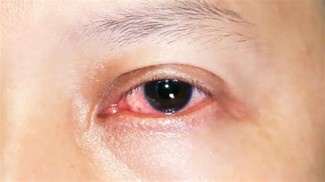 A Complete Guide to Keratitis Treatment and Prevention