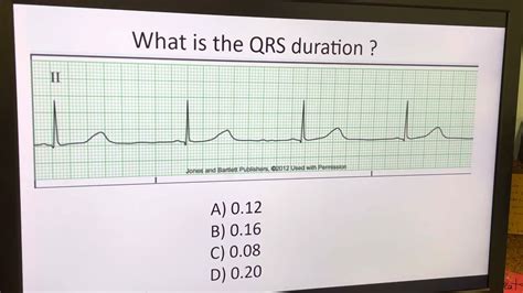 Telemetry Analysis: Video 2: Measuring the Duration of the QRS Complex - YouTube