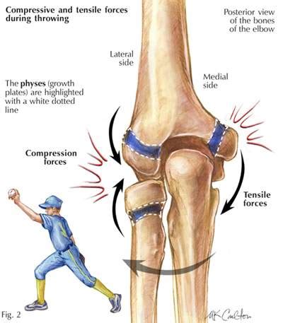 Does My Child Have "Little Leaguer's Elbow"? | ProActive Physical Therapy