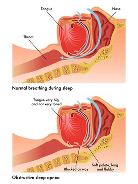 Obstructive Sleep Apnea