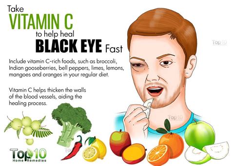 How to Get Rid of a Black Eye Fast | Top 10 Home Remedies