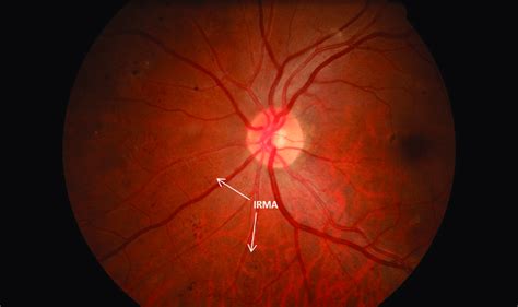 Severe nonproliferative diabetic retinopathy with intra-retinal... | Download Scientific Diagram