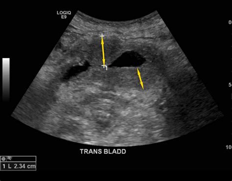 Cureus | Hypereosinophilic Syndrome, Multiorgan Involvement and Response to Imatinib