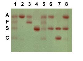 Blood Test: Hemoglobin Electrophoresis Procedure & Results | New Health Advisor