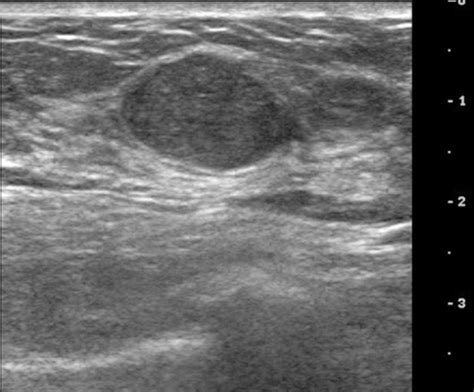 Ultrasound image of left breast taken 2 years after ori | Open-i