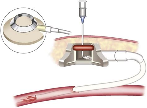 Indwelling Access Devices | Oncohema Key